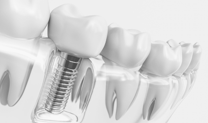 Featured image for “Looking For The Best Tooth Replacement Option? Consider Dental Implants”