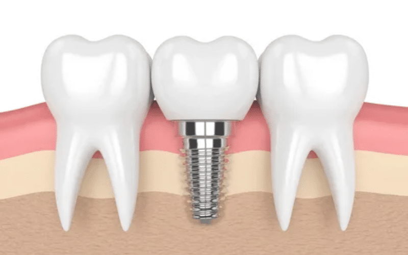 Featured image for “Dental Implants The Long-Term Solution To Missing Teeth And Their Benefits”