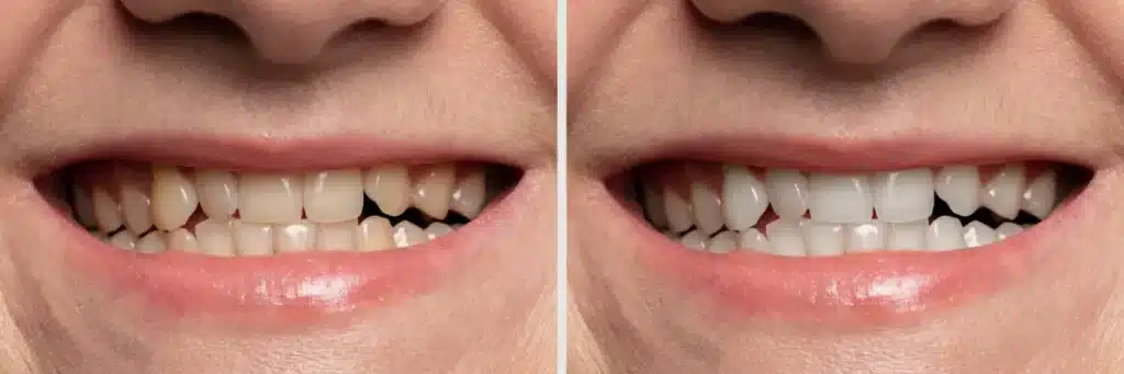 Benefits of Teeth Whitening Service - Before and After